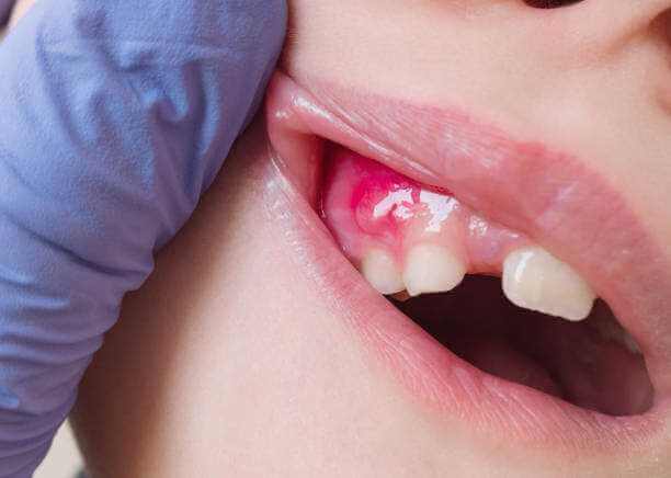 what-to-do-if-a-dental-abscess-bursts-on-its-own-in-waukesha-wi