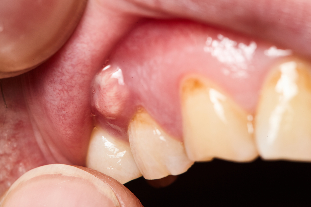 can antibiotics cure tooth abscess?